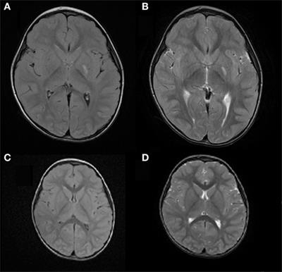 Acute Hemichorea Can Be the Only Clinical Manifestation of Post-Varicella Vasculopathy: Two Pediatric Clinical Cases
